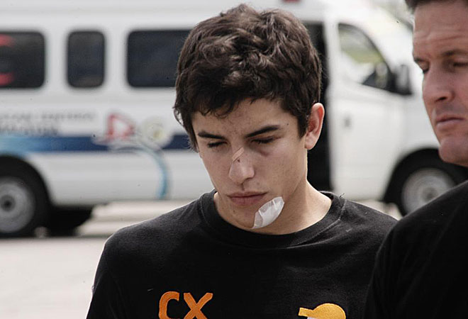 El accidente le dej� da�ado el ojo. Parec�a que la visi�n doble se le quitar�a a tiempo, pero no se le fue hasta varios meses despu�s.